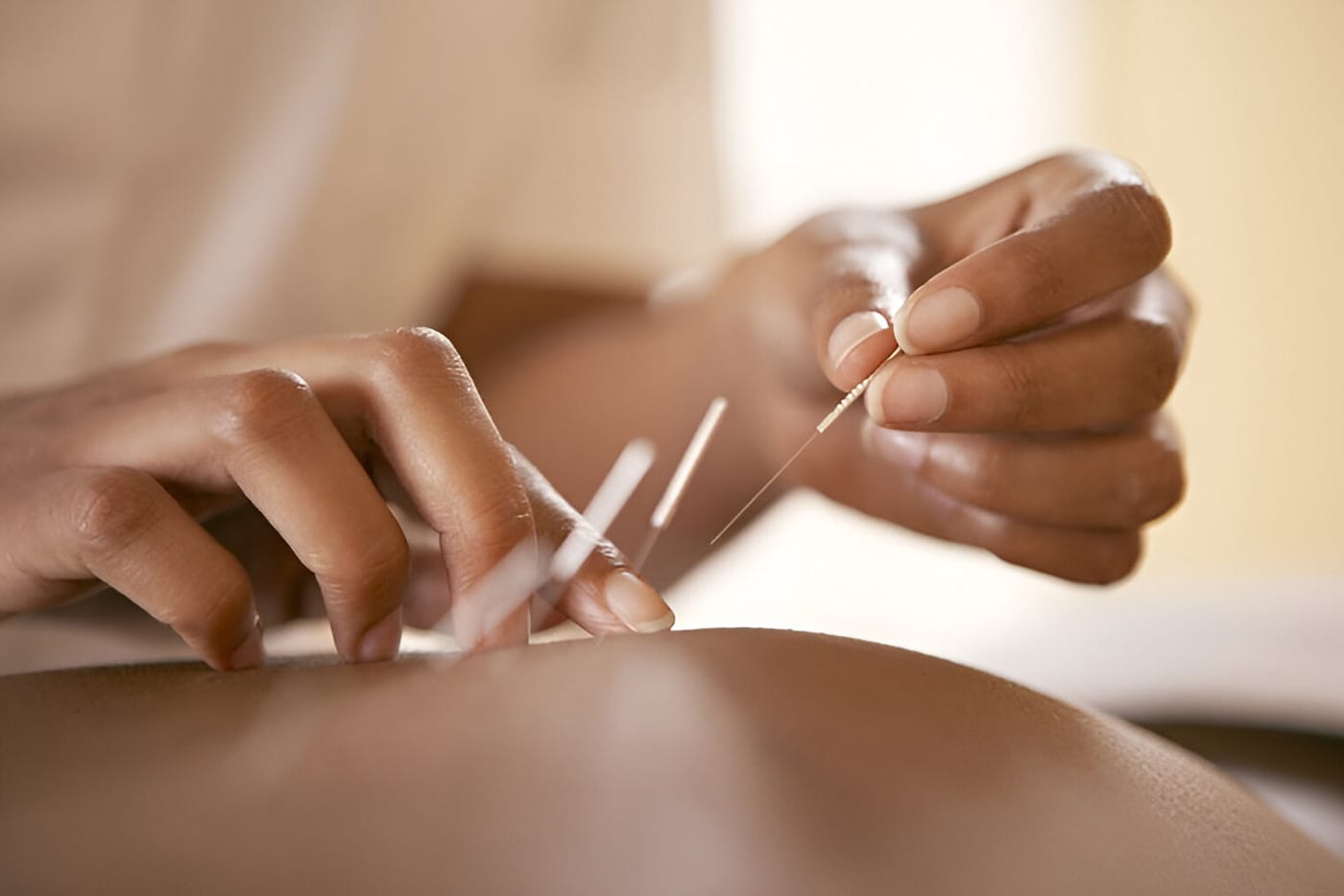 Acupuncture-in-Calgary